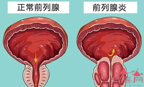 正常前列腺与前列腺炎内部表现