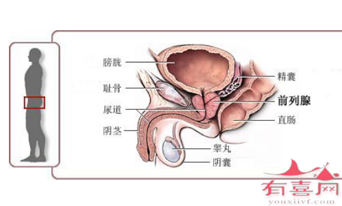 严重的前列腺炎能做试管婴儿吗