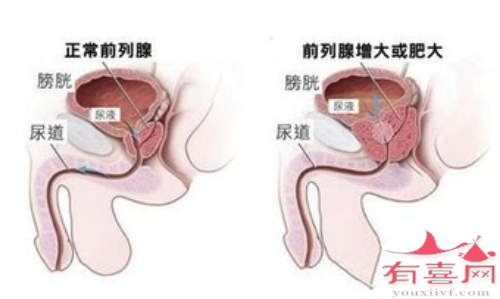 前列腺肥大有什么症状和危害性