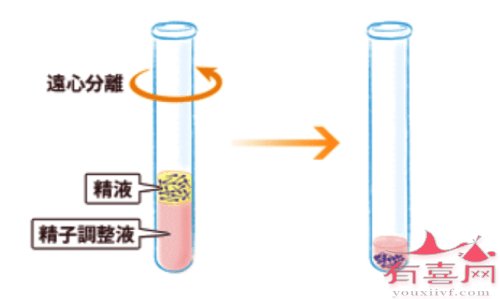 前列腺肥大增生能做试管婴儿吗