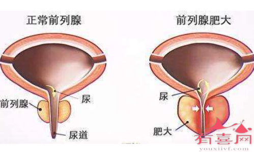 前列腺肥大需要手术的情况