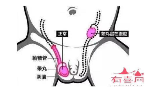 成人隐睾患者能做试管婴儿吗