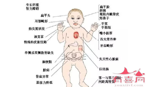 常见染色体异常导致的疾病