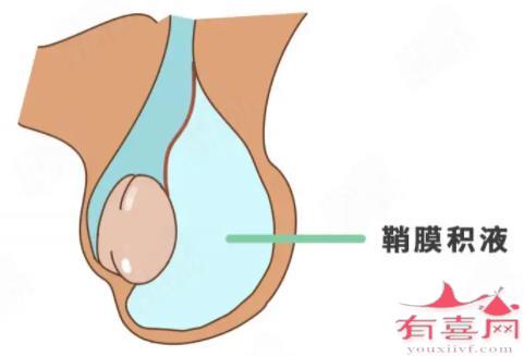 鞘膜积液