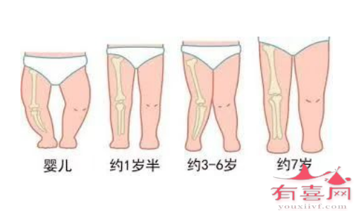 正常生理现象罗圈腿的变化