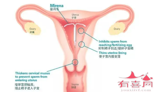 带曼月乐不会让腺肌症消失