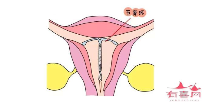 宫内避孕环的副作用