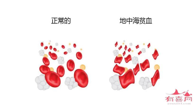 ﻿地中海贫血症状表现是什么样的